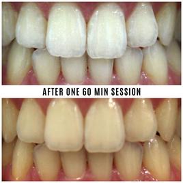 Mint Smilebar Power Whitening Kit - Instant LED Teeth Whitening Kit