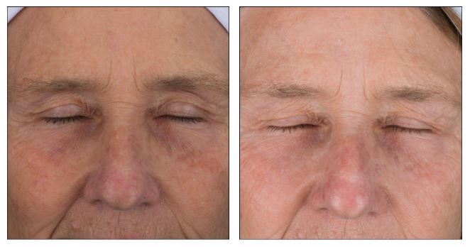 Stem Cell 3D Eye Lift | Aging Skin, Free Radical Damage, Fine Lines & Wrinkles